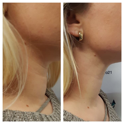 neck before - after